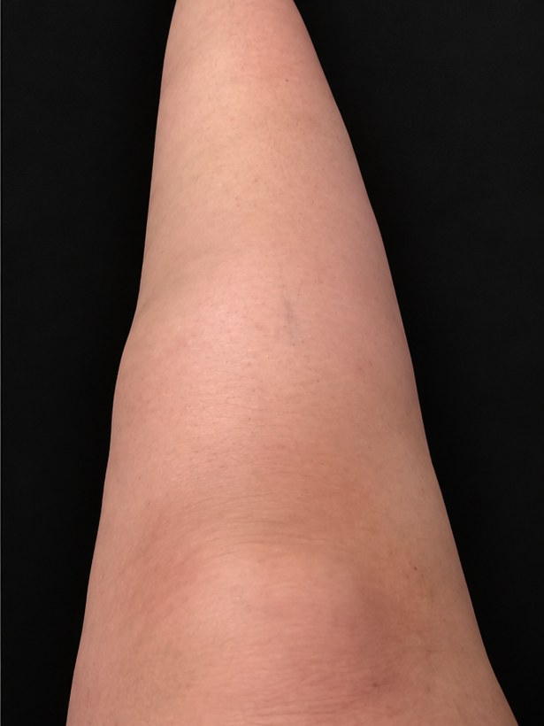 Perna de paciente com lipedema depois do acompanhamento, com menos inchaço e sem a vermelhidão