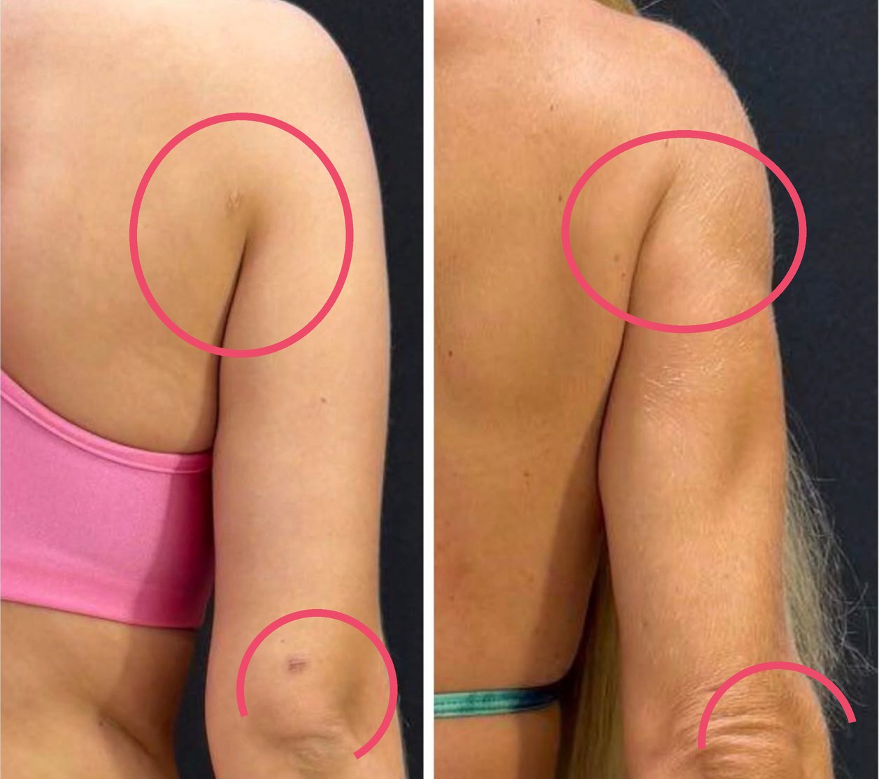 Duas cicatrizes de cirurgia no braço lado a lado, com as marcas circuladas em rosa