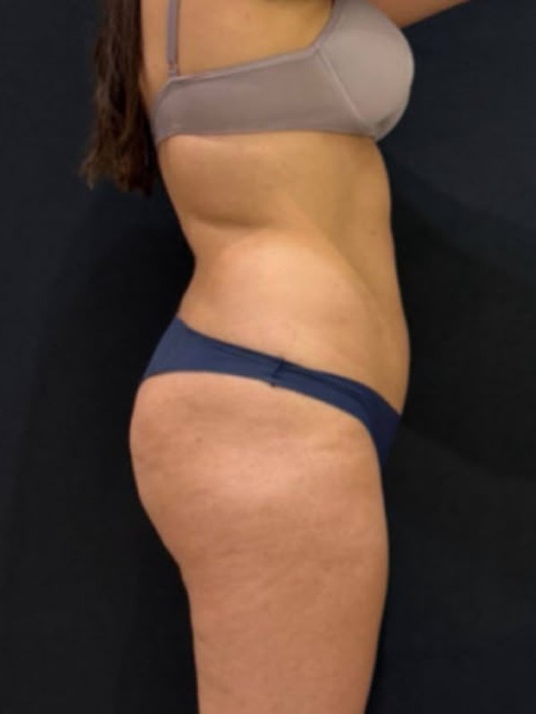 A mesma paciente de lado antes da cirurgia