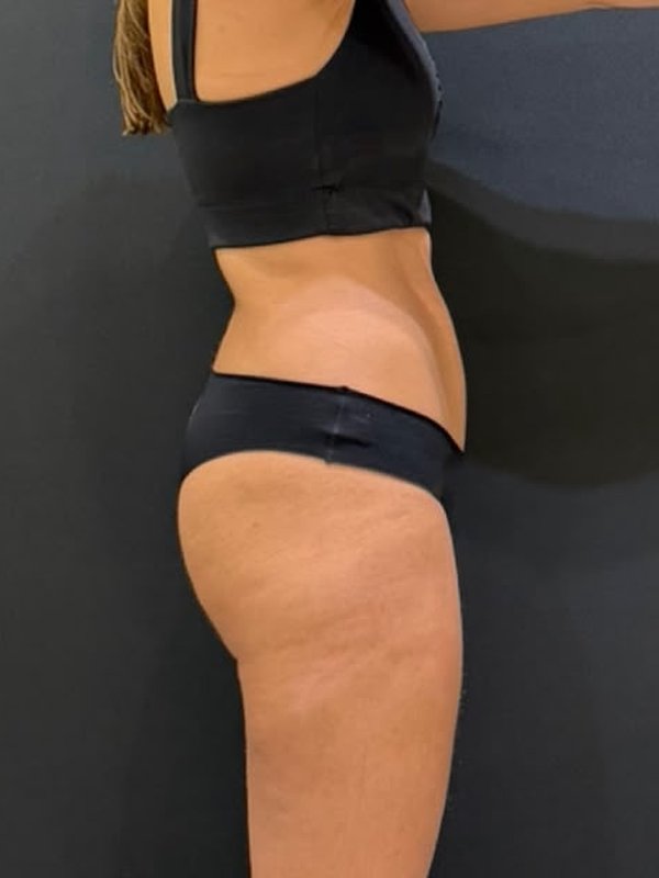 Paciente de lado depois da cirurgia, com a cintura mais definida